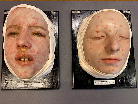 Links im Bild: Wachsmoulage des Gesichtes von Frieda W., welche während der letzten Epidemie in Zürich 1921 mit Pocken (Variola) angesteckt worden war. Hergestellt von Lotte Volger, Dermatologische Klinik, Kantonsspital Zürich