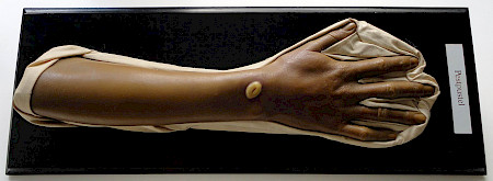 Moulage Pestpustel aus der Medizinhistorischen Sammlung der Universität Bern